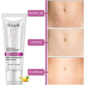 Mango Remove Pregnancy Scars Acne Cream Stretch Marks Treatment Maternity Repair Anti-Aging Anti-Winkles Firming Body Creams